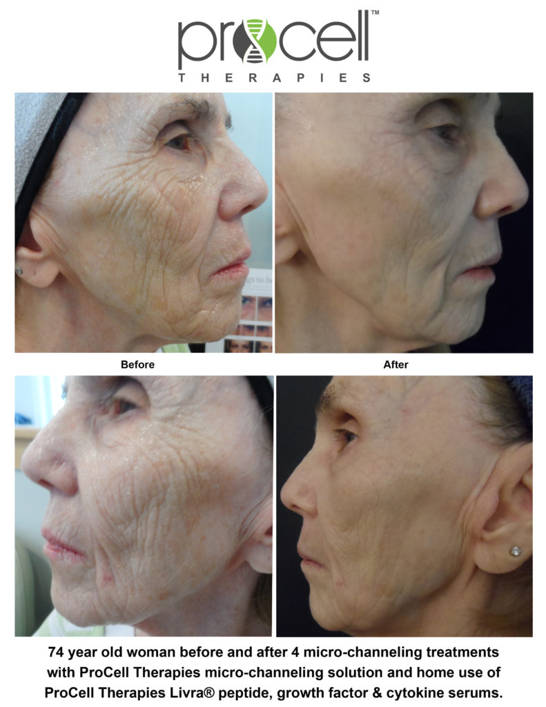 Procell 74 year old woman before and after