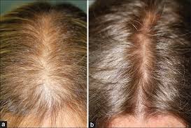 hairloss before and after