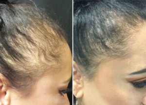 woman hairloss before and after