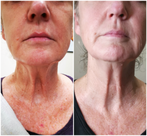 Radiofrequency Neck lift Treatment